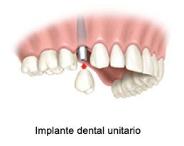 Implantología El Prat