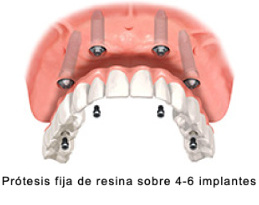 Implantología clínica dental Eva Flores El Prat