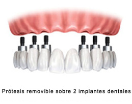 Implantología clínica dental Eva Flores