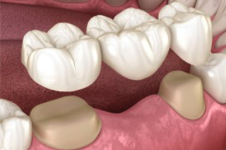 Prótesis dentales el Prat de Llobregat